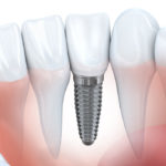 10 interessante Fakten über Zahnimplantate